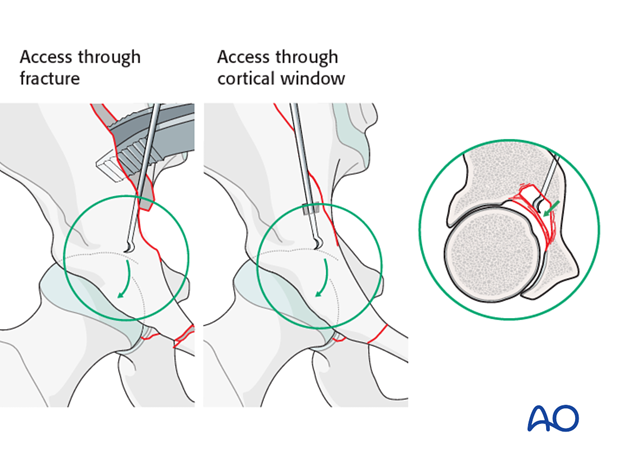 orif through ilioinguinal approach