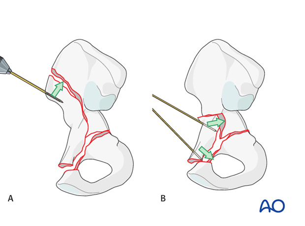 orif through ilioinguinal approach