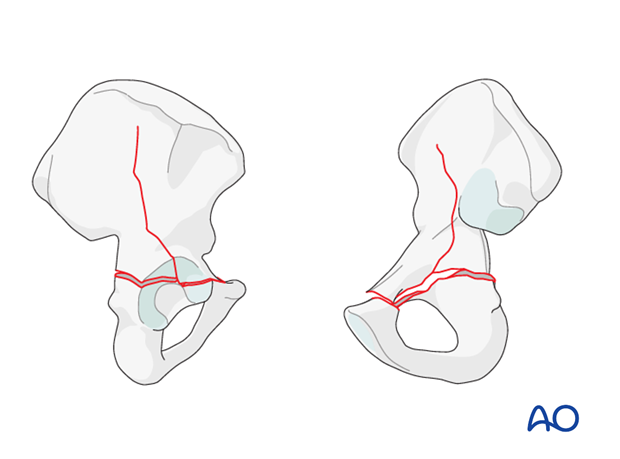 orif through ilioinguinal approach