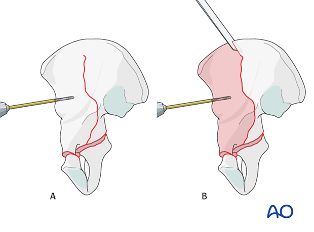 orif through ilioinguinal approach