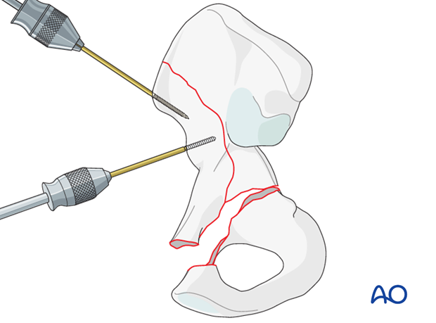 orif through ilioinguinal approach