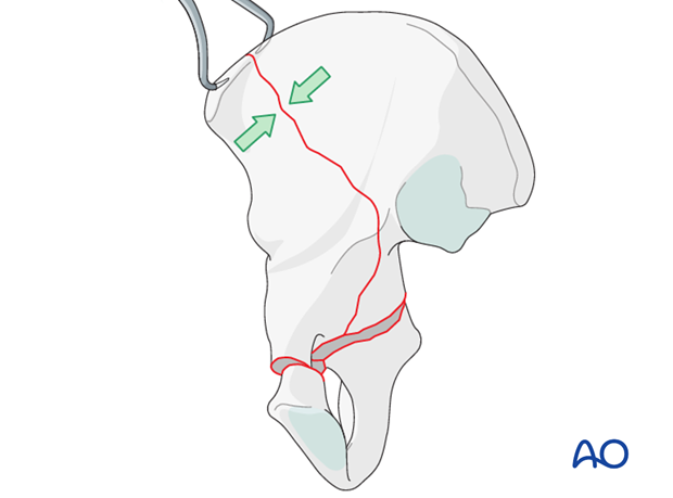 orif through ilioinguinal approach