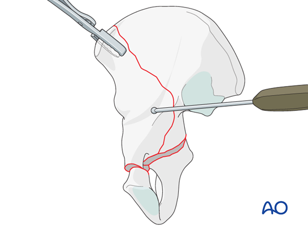 orif through ilioinguinal approach