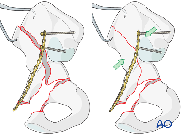 orif through ilioinguinal approach