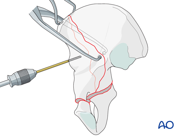 orif through ilioinguinal approach