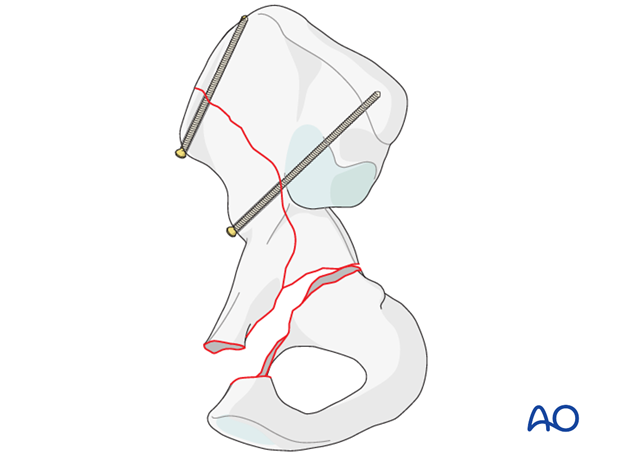 orif through ilioinguinal approach