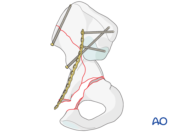 orif through ilioinguinal approach