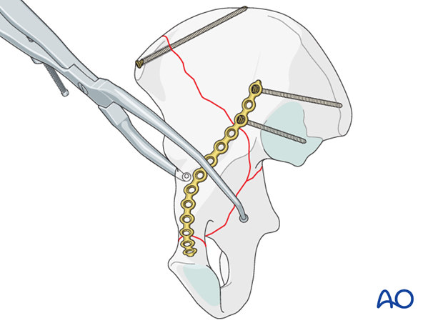 orif through ilioinguinal approach