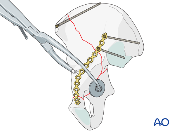 orif through ilioinguinal approach