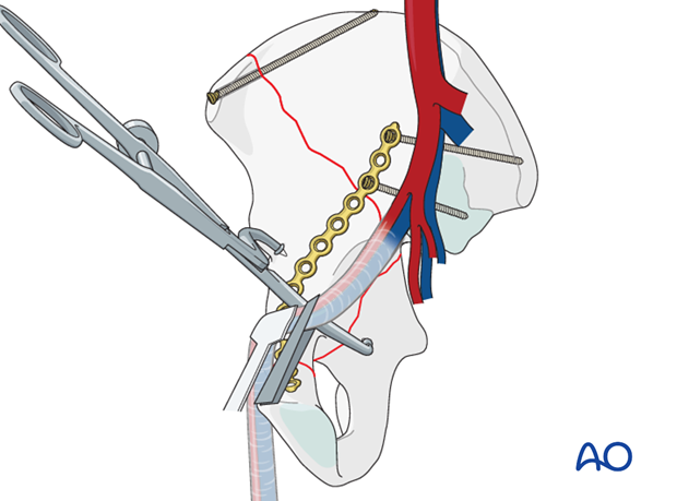 orif through ilioinguinal approach