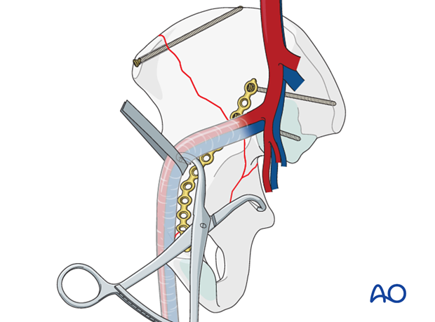 orif through ilioinguinal approach