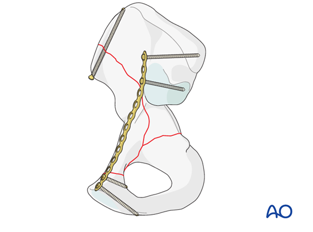 orif through ilioinguinal approach