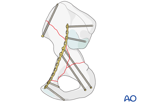 anterior column and posterior hemitransverse