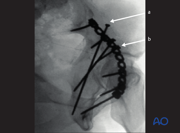 orif through ilioinguinal approach