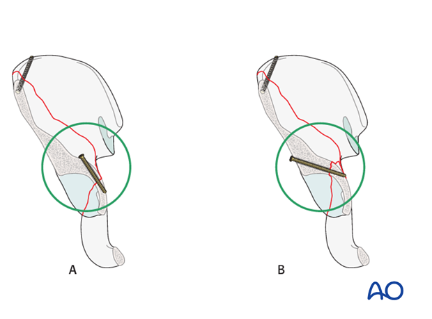 orif through ilioinguinal approach