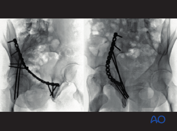 orif through ilioinguinal approach