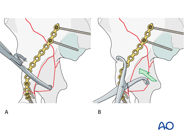 orif through ilioinguinal approach