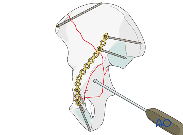 orif through ilioinguinal approach