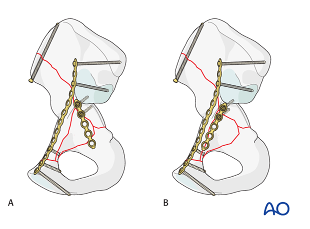 orif through ilioinguinal approach