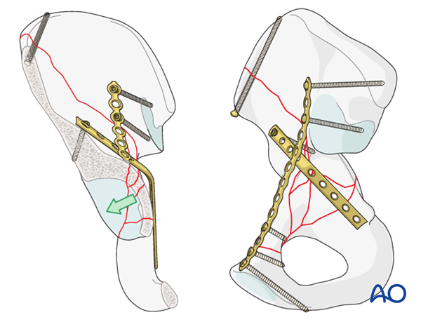 orif through ilioinguinal approach