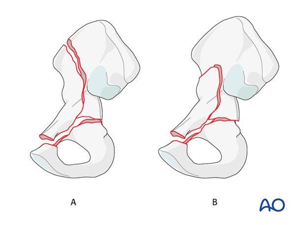 orif through sequential approaches