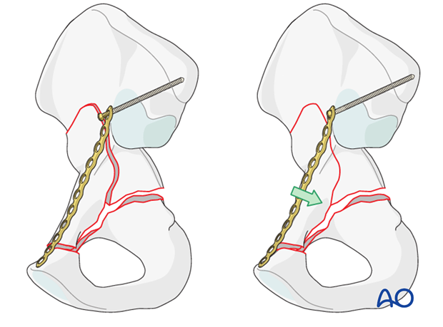 orif through sequential approaches