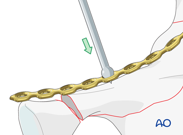 orif through sequential approaches