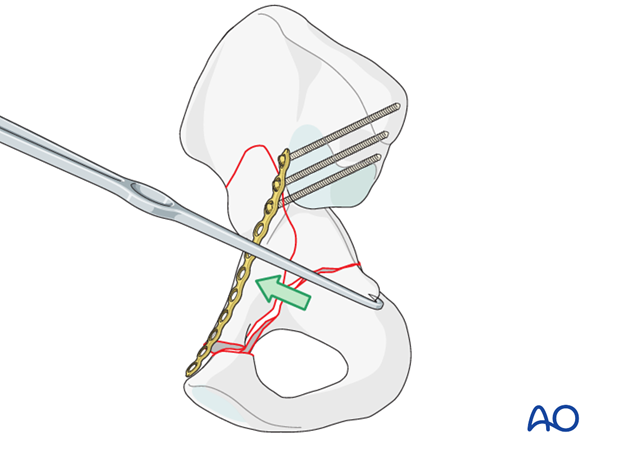 orif through modified stoppa approach