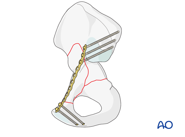 orif through modified stoppa approach