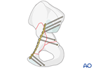 anterior column and posterior hemitransverse