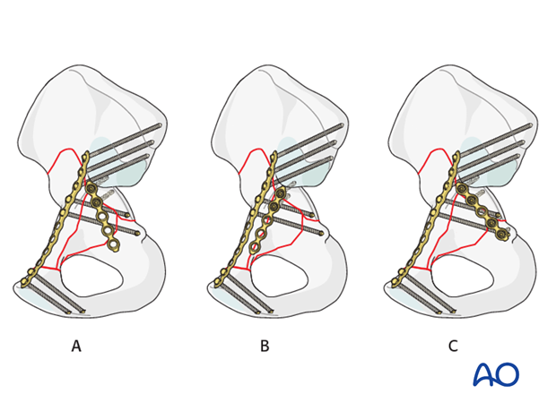 orif through modified stoppa approach