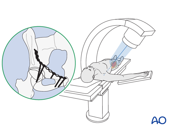 orif through modified stoppa approach