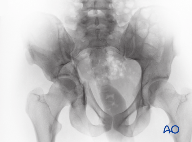 radiology of the intact acetabulum