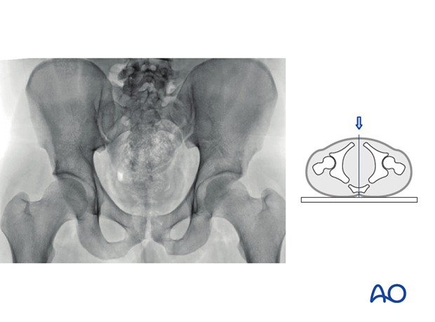 radiology of the intact acetabulum