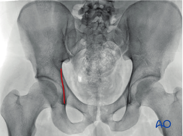 radiology of the intact acetabulum