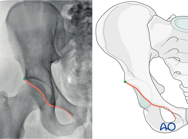 radiology of the intact acetabulum