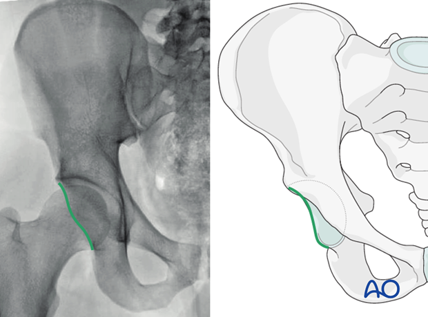 radiology of the intact acetabulum