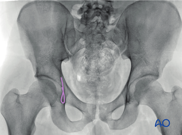 radiology of the intact acetabulum