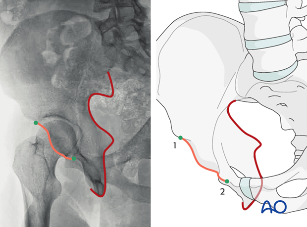 radiology of the intact acetabulum