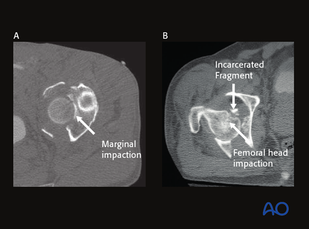 radiology of the intact acetabulum