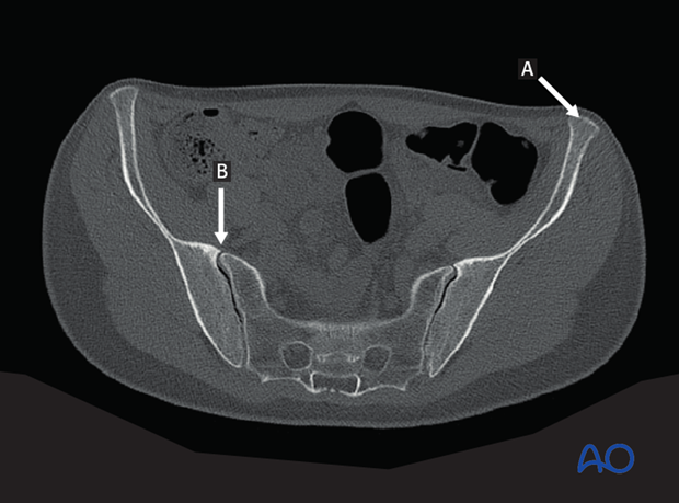 radiology of the intact acetabulum