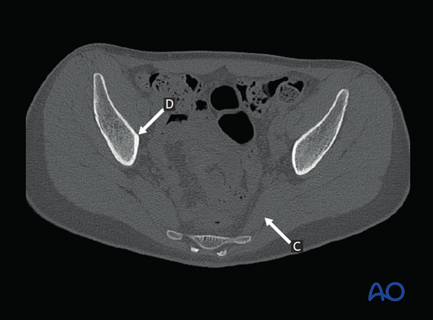 radiology of the intact acetabulum