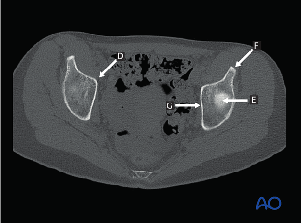 radiology of the intact acetabulum