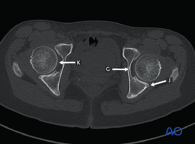 radiology of the intact acetabulum