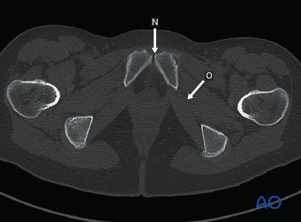 radiology of the intact acetabulum