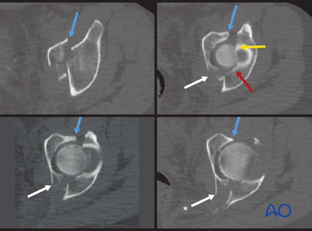 radiology of the intact acetabulum