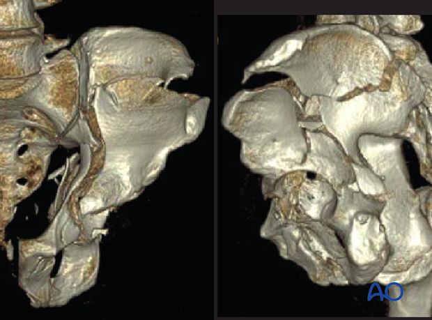 radiology of the intact acetabulum