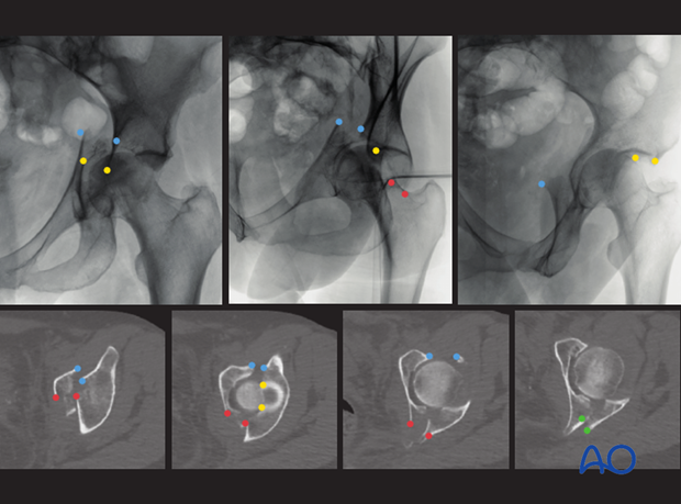 radiology of the intact acetabulum