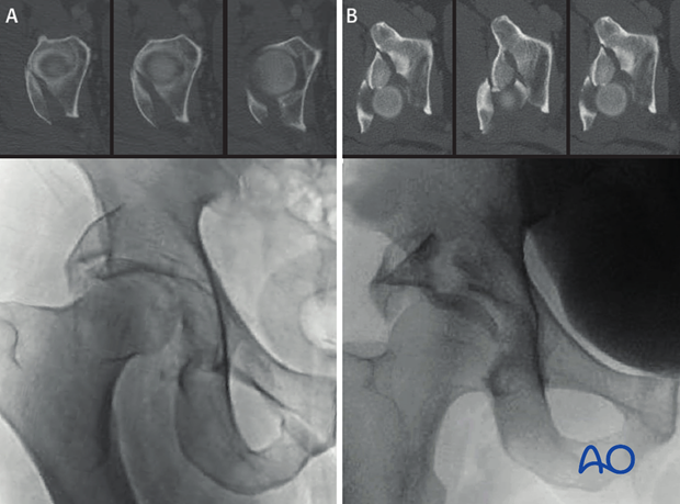 characteristics of elemental fracture types