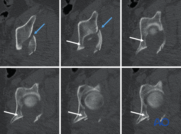 characteristics of elemental fracture types